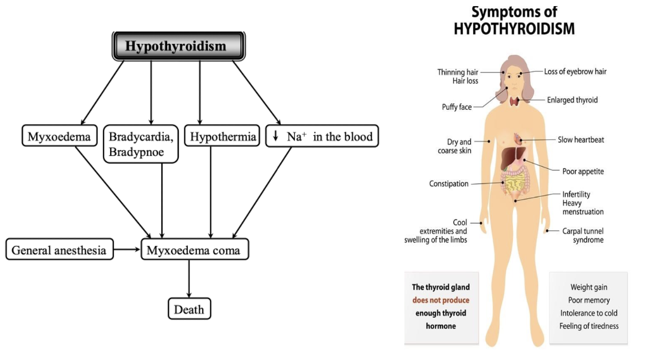 <p>Thyroid hypofunction, also known as hypothyroidism, is a condition where the thyroid gland does not produce enough thyroid hormones, leading to slow metabolism and various systemic effects such as weight gain, fatigue, cold intolerance, and developmental issues in young animals. </p><p></p><p><span><strong>Thyroid hypofunction (hypothyroidism) = </strong>a<strong> </strong>condition in which thyroid hormone secretion is inadequate to maintain normal levels of target tissue stimulation. Can be primary, secondary, and tertiary.</span></p><p class="MsoListParagraphCxSpFirst"><span>·</span><span style="font-size: 7pt; font-family: &quot;Times New Roman&quot;">&nbsp;&nbsp;&nbsp;&nbsp;&nbsp; </span><span><strong>Primary hypothyroidism</strong> caused by: Goitrogens, Iodine deficiency, Thyroid neoplasia, Lymphocytic thyroiditis, idiopathic atrophy of thyroid gland, absence of enzymes involved in the thyroidal hormones, thyroid agenesis, or dysharmonogenesis ( congenital hypothyroidism)</span></p><p class="MsoListParagraphCxSpMiddle"><span>·</span><span style="font-size: 7pt; font-family: &quot;Times New Roman&quot;">&nbsp;&nbsp;&nbsp;&nbsp;&nbsp; </span><span><strong>Secondary hypothyroidism</strong> caused by: tumors, congenital pituitary malformations, a sequelae of the treatment of pituitary tumors with surgery, isolated TSH deficiency ( pituitary destruction)</span></p><p class="MsoListParagraphCxSpLast"><span>·</span><span style="font-size: 7pt; font-family: &quot;Times New Roman&quot;">&nbsp;&nbsp;&nbsp;&nbsp;&nbsp; </span><span><strong>Tertiary hypothyroidism</strong> caused by hypothalamic dysfunction</span></p><p class="MsoNormal"><span><strong><u>Physiological consequences of hypothyroidism:</u></strong></span></p><p class="MsoNormal"><span> <u>Calorigenesis and thermoregulation:</u> decreased basal metabolic rate and O2 consumption  lethargy, weakness, <strong>hypothermia</strong>, cold intolerance</span></p><p class="MsoNormal"><span> <u>Growth and maturation:</u> mental retardation in youngs and dullness in adults</span></p><p class="MsoNormal"><span> <u>Carbohydrate metabolism:</u> decreased glycogenolysis and glycolysis  <strong>weight gain without increase in food intake</strong></span></p><p class="MsoNormal"><span> <u>Protein metabolism:</u> decreased synthesis, and increased degradation of protein  weakness, poor hair coat, alopecia, hyperkeratosis</span></p><p class="MsoNormal"><span> <u>Cardiovascular system</u>: <strong>bradycardia, low blood pressure and pulse</strong></span></p><p class="MsoNormal"><span> <u>Neuromuscular system</u>: muscle atrophy</span></p><p class="MsoNormal"><span> <u>GIT:</u> constipation</span></p><p class="MsoNormal"><span> <u>skin:</u> dry cool, yellow orange color</span></p><p class="MsoNormal"><span> <u>immunity:</u> suppression of humoral and cellular immunity</span></p><p class="MsoNormal"><span> <u>hematologic alterations</u>: normocytic, normochromic anemia, von Willebrand disease</span></p><p class="MsoNormal"><span> <u>respiratory system:</u> <strong>bradypnoe</strong></span></p><p class="MsoNormal"><span> <u>endocrine system:</u> decreased GH secretion</span></p><p class="MsoNormal"><span> <u>reproductive system:</u> decreased function</span></p><p class="MsoNormal"><span> <u>lipid metabolism:</u> hypercholesterolemia</span></p><p class="MsoNormal"></p><p class="MsoNormal"><strong>Goiter </strong>= thyroid gland enlargement resulting from prolonged stimualtion by TSH in hypothyroidism or in hyperthyroidism (TSH in pituitary adenoma)</p><p class="MsoNormal"><strong>Goitrogens </strong>= factors that block thyroid hormone synthesis either in food or in medication</p>