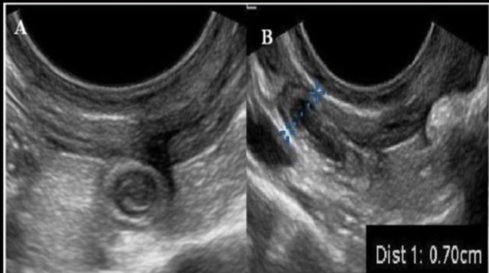 <p>a pt has moderate RLQ + low grade fever. a US exam of area shows 7mm thick aperistaltic tube that is noncompressible</p><p>a) peritoneal inclusion cyst</p><p>b) intussusception</p><p>c) pelvic congestion</p><p>d) appendicitis</p>