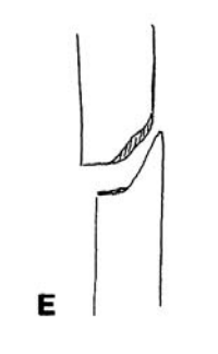 <p>Indirect fractures Angulation + compression </p>