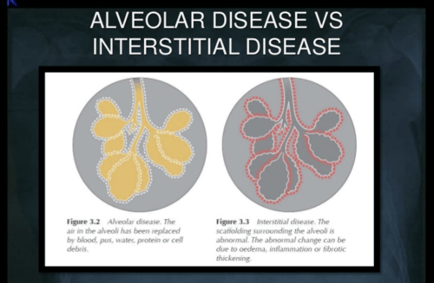 <p>tissue outside of the alveoli are affected. (diffuse)</p>