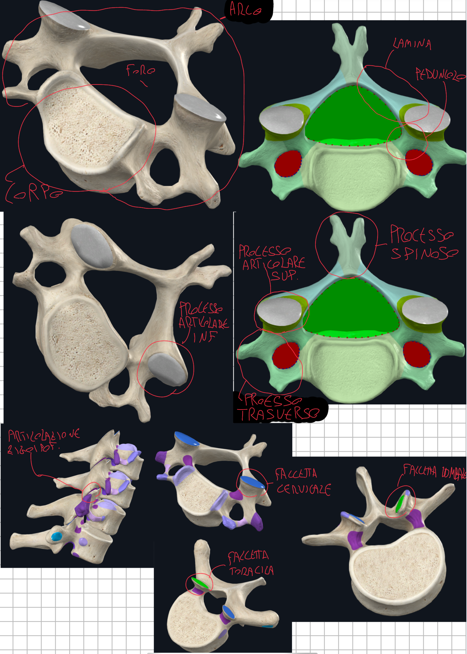 <p>Due elementi principali:</p><ul><li><p>Corpo Vertebrale → parte anteriore, più voluminosa, forma cilindrica/ovale → sostiene il peso e lo trasmette lungo la colonna</p></li><li><p>Arco Vertebrale → origina dalla faccia posteriore del corpo → è formato da due peduncoli (che si proiettano posteriormente dal corpo) e due lamine (proseguono dai peduncoli e si fondono sulla linea mediana)</p></li><li><p>Tra il corpo e l’arco si avrà il Foro Vertebrale → l’insieme di tutti i fori vertebrali di tutte le vertebre forma il Canale Vertebrale che contiene midollo spinale e radici nervose spinali.</p></li></ul><p>Dall’Arco Vertebrale si distinguono 7 processi:</p><ul><li><p>1 Processo Spinoso → impari e mediano → si proietta posteriormente dalla fusione delle due lamine</p></li><li><p>2 Processi Trasversi → laterali → insieme allo spinoso fungono da leve e inserzione per muscoli.</p></li><li><p>4 Processi Articolari → due superiori e due inferiori, pari e simmetrici → originano tra peduncolo e lamina → si articolano con i processi articolari di vertebre adiacenti formando le ARTICOLAZIONI ZIGOAPOFISARIE (o interapofisarie) </p></li></ul><p>Articolazioni Zigoapofisarie:</p><ul><li><p>Sono articolazioni sinoviali rivestite da cartilagine ialina </p></li><li><p>I processi articolari superiori di una vertebra si articolano con quelli inferiori di una vertebra sovrastante e viceversa.</p></li><li><p>La superfici dei processi è diversa nei vari tratti → ciò determina i movimenti consentiti per ogni segmento della colonna</p></li><li><p>Nel tratto cervicale, le faccette articolari sono orientate obliquamente (quasi orizzontale) → ciò determina alta mobilità (favorita flesso-estensione, inclinazione laterale, rotazione)</p></li><li><p>Nel tratto toracico, le faccette articolari sono orientate in un piano frontale (quasi verticale) → meno mobili (favorita la rotazione, limitata flesso-estensione e inclinazione laterale) (meno mobile soprattutto per la presenza della gabbia toracica)</p></li><li><p>Nel tratto lombale, le faccette articolari sono orientate in piano sagittale → molto mobile (è favorita flesso-estensione, è limitata la rotazione)</p></li></ul><p></p>