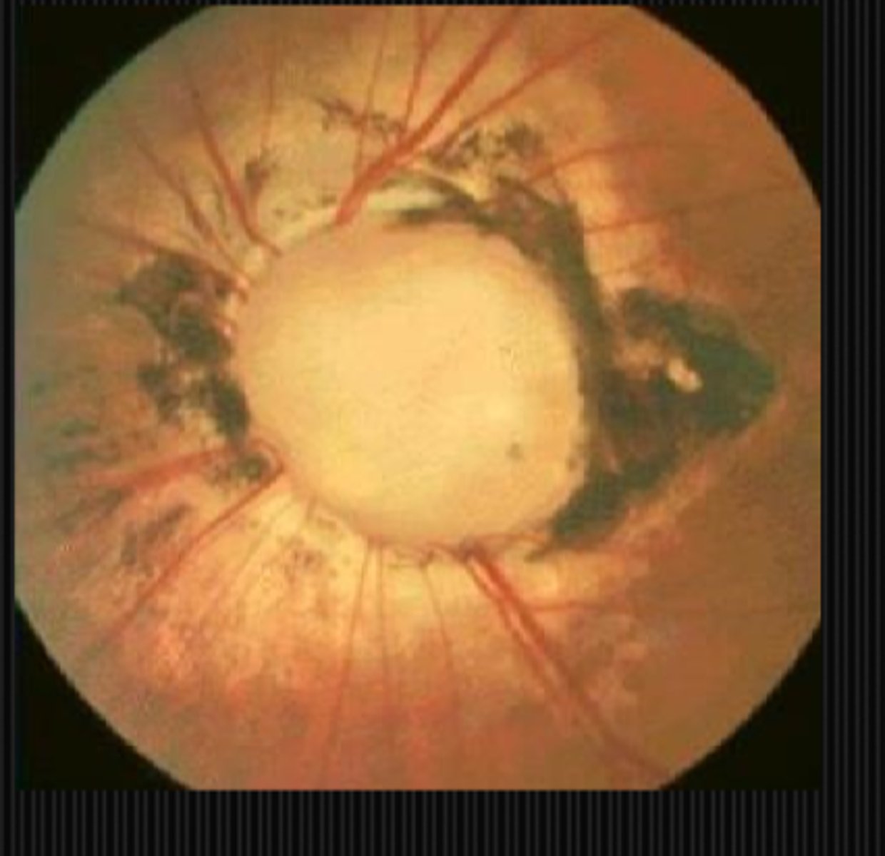<p>congenital anomalies like tilted disc, coloboma, optic pits, morning glory nerve</p>