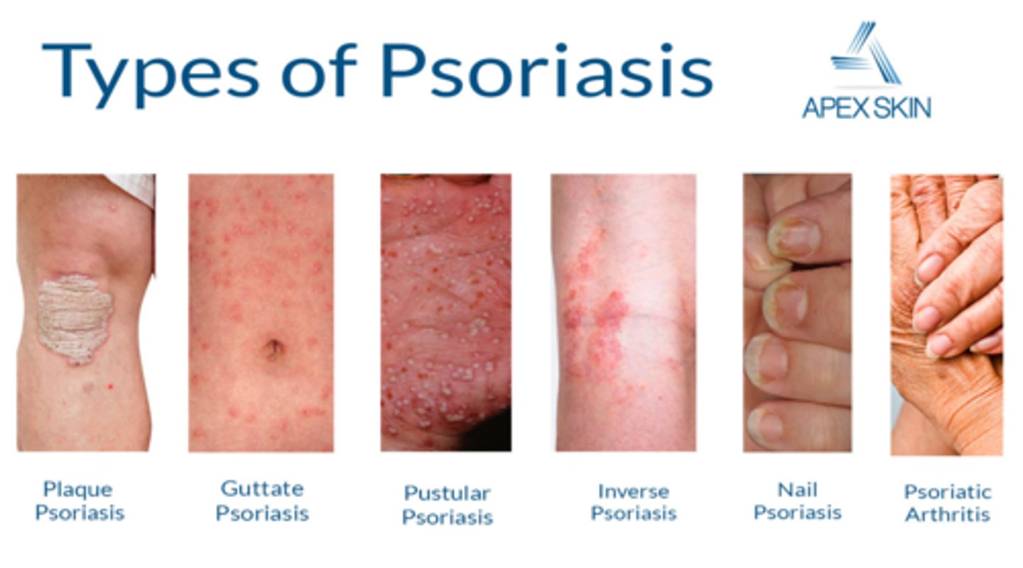 <p>Psoriasis</p>