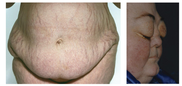 <ul><li><p>affecting the adreanal gland</p></li><li><p><span style="background-color: transparent;"><span>is due to </span><u><span>hypersecretion</span></u><span> of adrenocorticotrophic hormone (A C T H) from the pituitary gland</span></span></p></li><li><p><span style="background-color: transparent;"><span>This causes the adrenal gland to produce too much </span><u><span>cortisol</span></u></span></p></li><li><p>buffalo hump</p></li></ul><p></p>