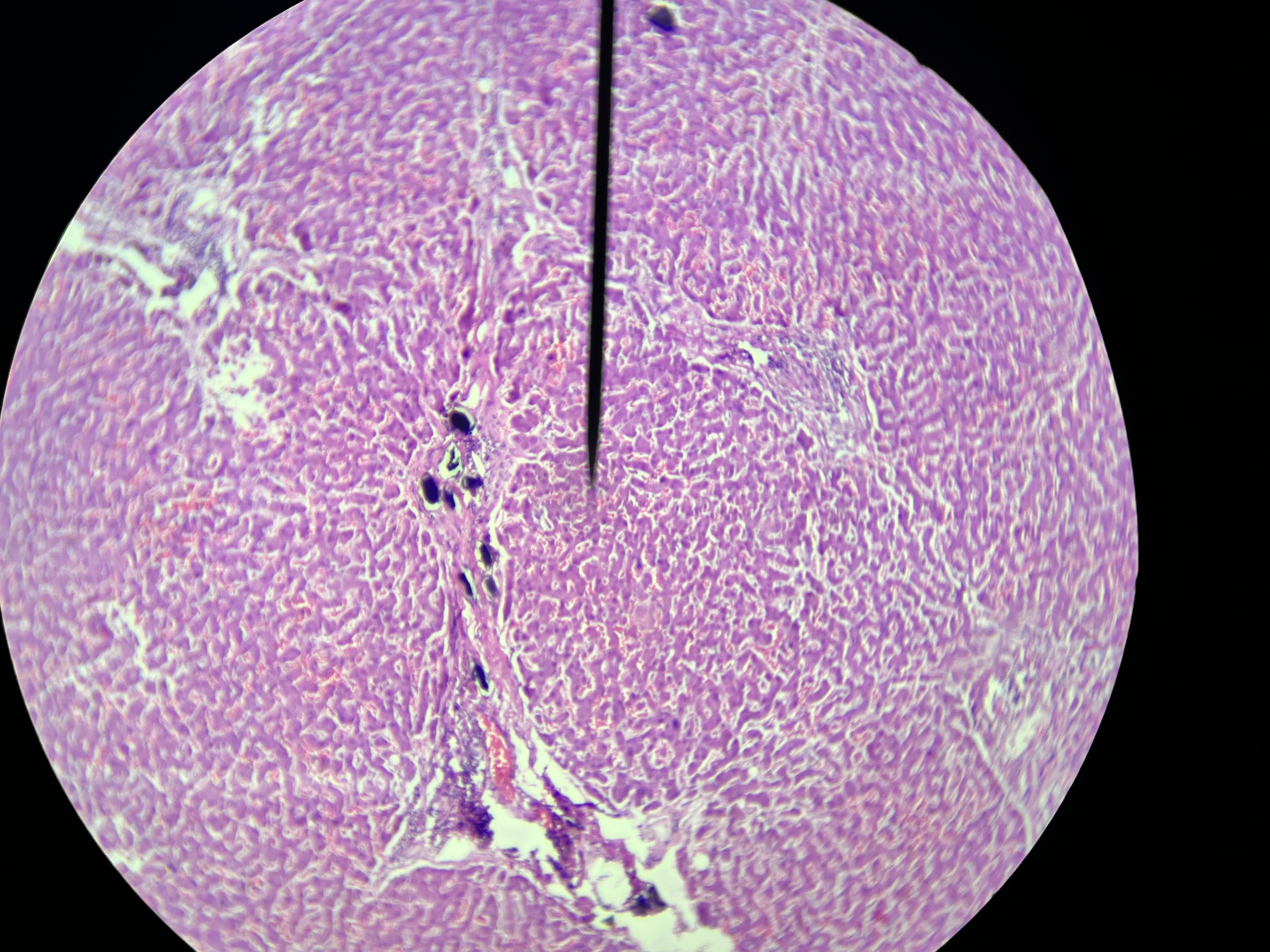 <p>A parasitic disease caused by Schistosoma species, characterized by liver inflammation, fibrosis, and potential complications such as portal hypertension. </p>