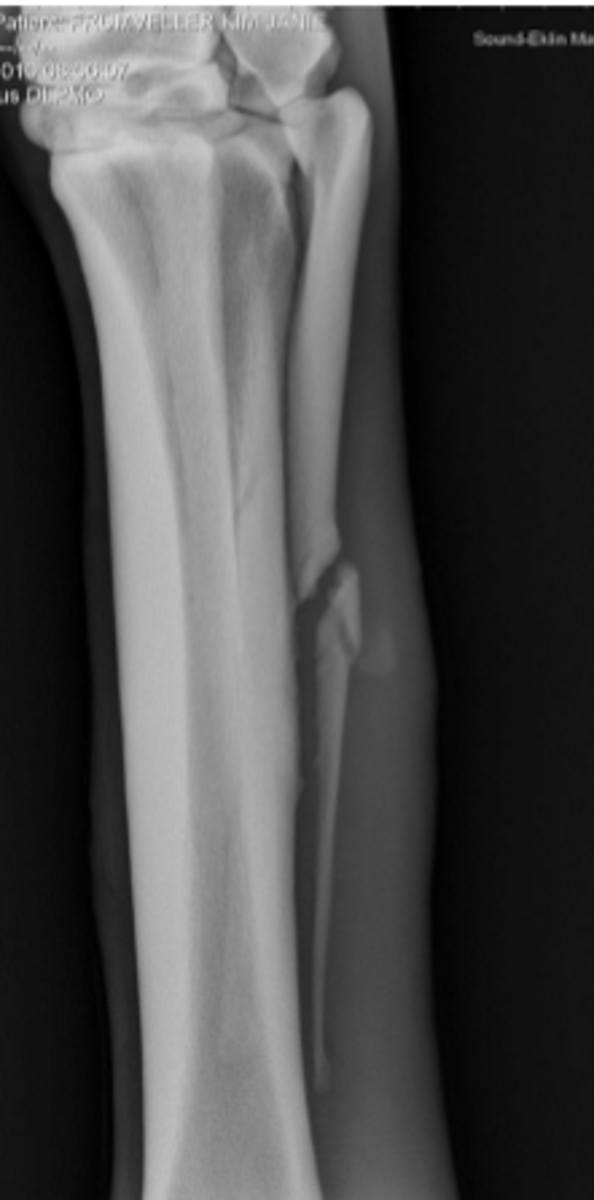 <p>How is this fracture treated?</p>