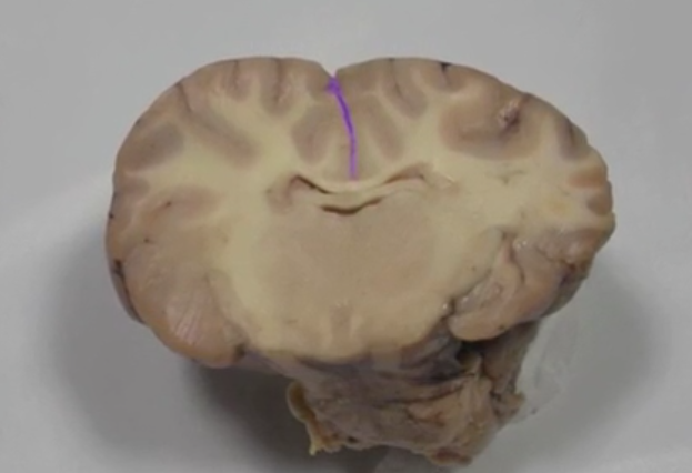 <p>Longitudinal Fissure </p>