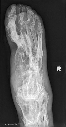 <p>commonly occurs in the metaphyseal area of the bone and can spread to the surface. most common in the lower extremities but can also occur in vertebrae. most common in children under five with a higher incidence in males. This is a secondary infection caused by staphylococcal bacteria- may remain dormant. develops in phases (formation of a sequestrum, formation of involucrum, formation of a new irregular bone around the abscess, migration of staphylococcal bacteria. internal bone is usually thickened with irregular patches of sclerosis = honeycomb effect. good prognosis and treated with antibiotics. complications include necrosis and septic arthritis </p>