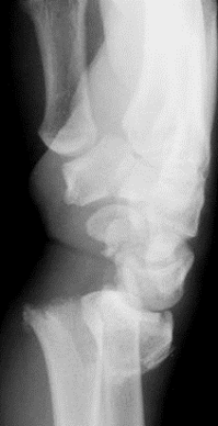 <p>Smith (fracture)</p>