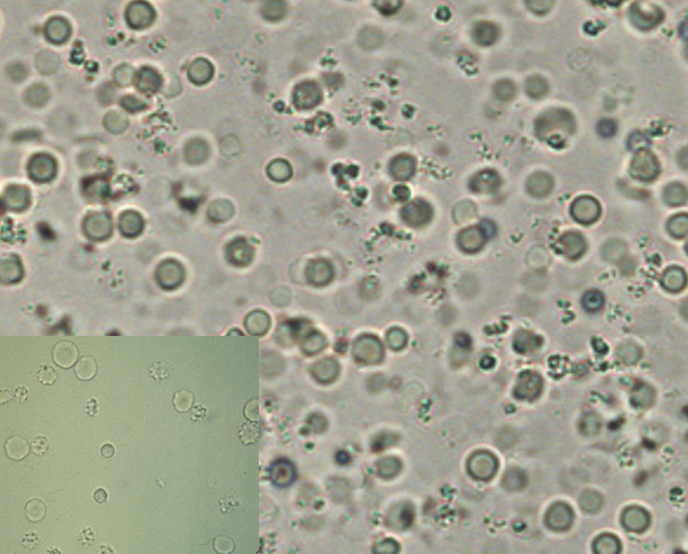 <p>What type of cell is shown from this urinalysis? What does it indicate?</p>