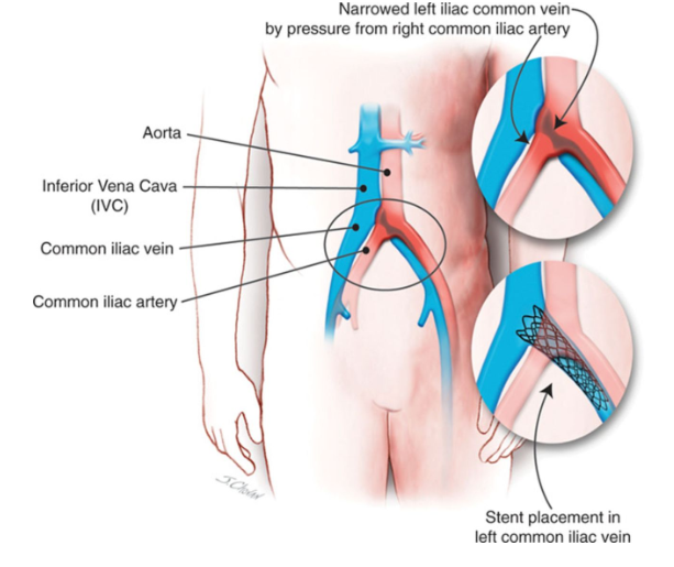 <p>What is May Thurners syndrome</p>