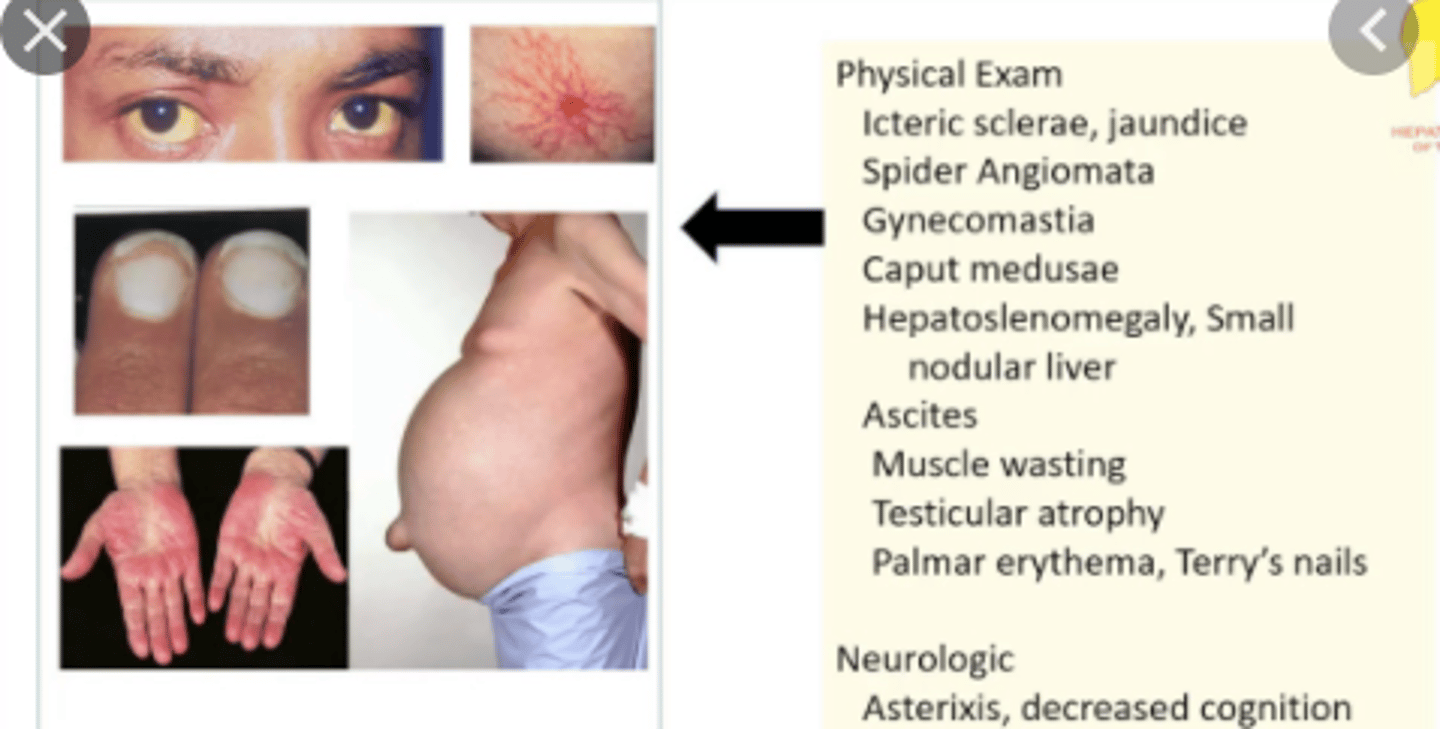 <p>- spider angiomata</p><p>- caput medusa</p><p>- Hepatomegaly</p>