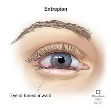 <p>PP/E: lid margin turns inward→lower lashes irritate conjunctiva+lower cornea</p><p>E: elderly</p><p>CM: lower eyelid rolled in→lower eyelashes invisible/not present<br>eyelashes grow in normal spot</p>