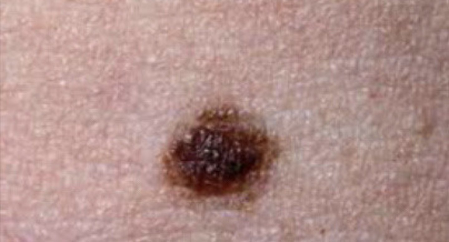 <p>Hereditary (birthmark), Sun exposure</p>