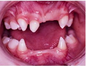 <ul><li><p>can be associated with anodontia</p></li><li><p>many of the components of the tooth germ are indirectly or directly of ectodermal origin</p></li><li><p>dysplasia- displaced</p></li><li><p>displaced ectoderm</p></li></ul><p></p>