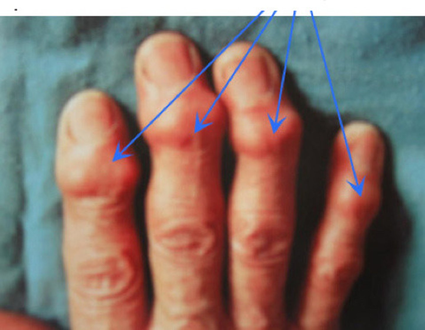 <p>súlyos ízületi kopásnak (csontos felrakódások, nem rosszindulatúak)</p>