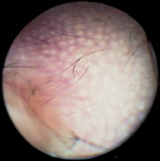 <p>Reactive hyperplasia caused by<strong> chronic otitis externa</strong></p>
