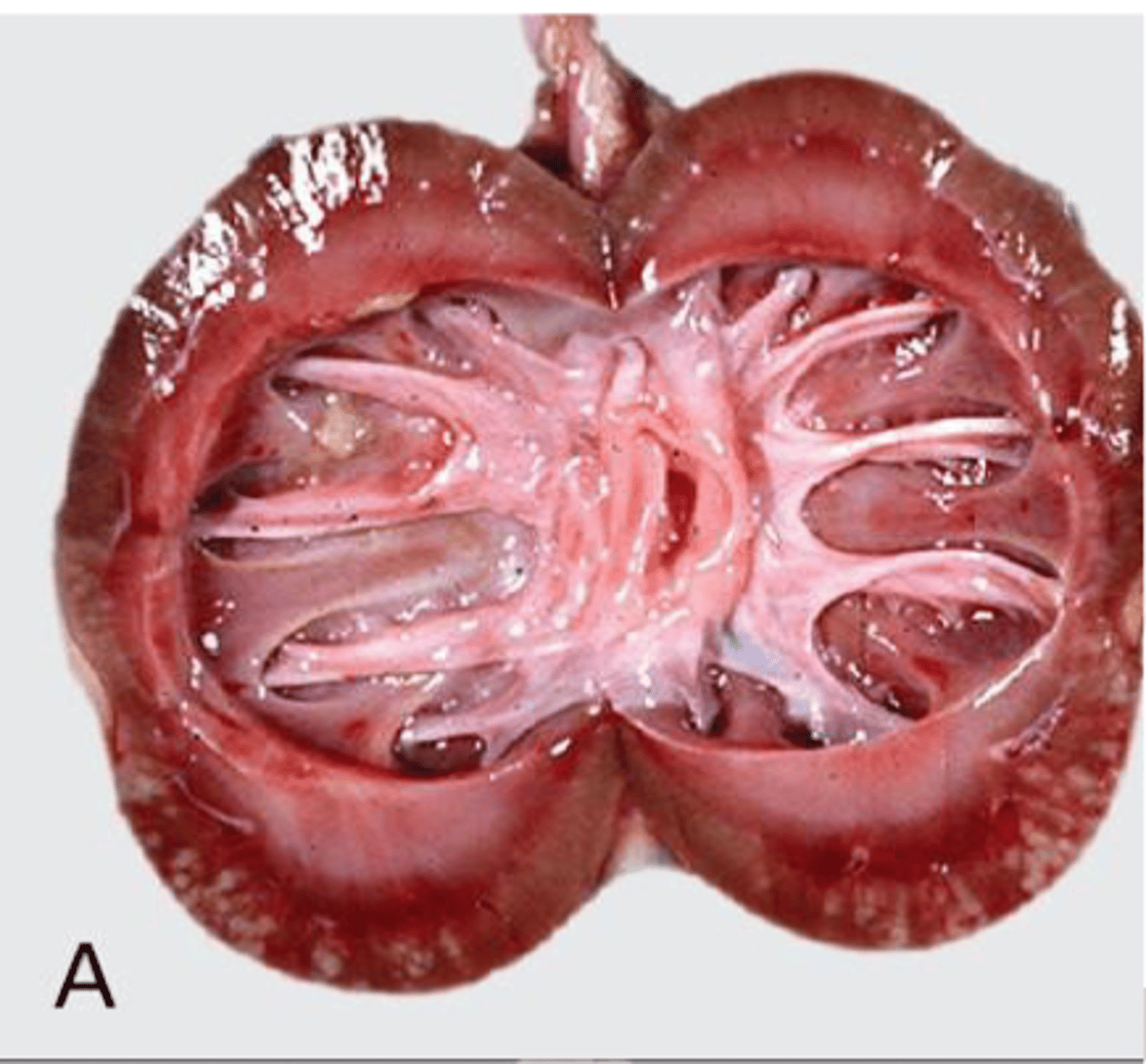 <p>Dilation of one or both kidneys with fluid</p><p>Dilation of the renal pelvis due to obstruction of urine outflow leads to increased pelvic pressure &amp; atrophy of renal parenchyma</p><p>Intrapelvic pressure increases &amp; blood vessels collapse</p><p>Reduced renal blood flow causes ischemia, tubular loss, &amp; fibrosis</p><p>*If unilateral, other kidney may be able to compensate*</p>