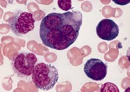 <p>A. Bizarre multinucleated erythroblasts</p><p> There are four classifications of CDAs, each characterized by ineffective erythropoiesis, increased unconjugated bilirubin, and bizarre multinucleated erythroid precursors.</p>