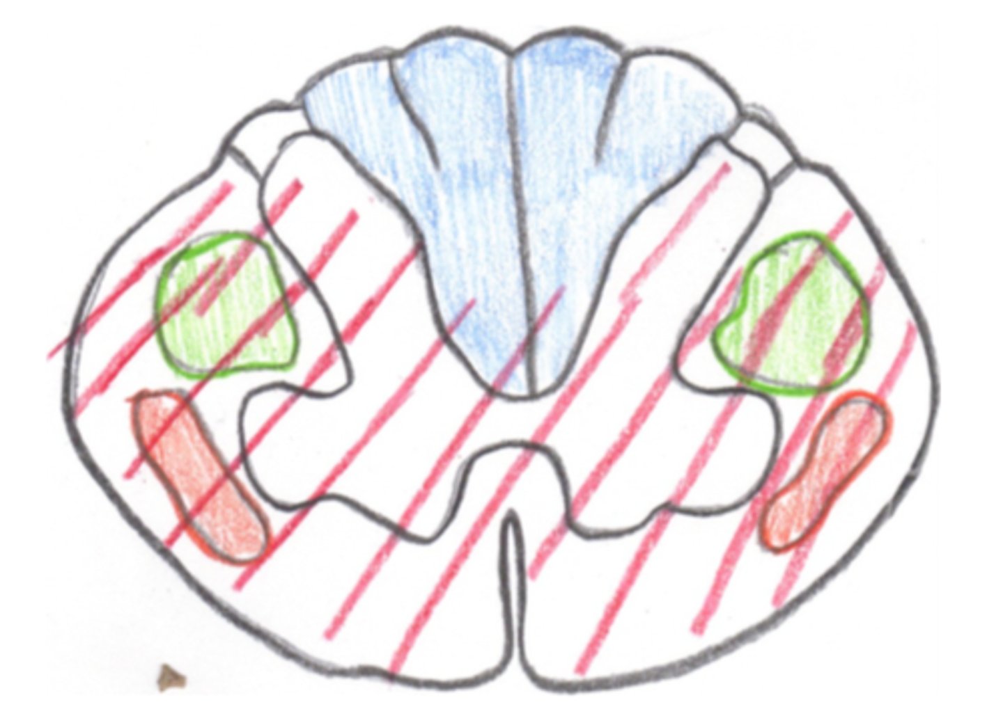 <p>This image depicts the damage associated with which Incomplete SCI Syndrome?</p>