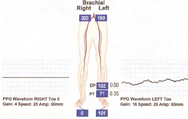 <p>This patient has an above-knee amputation. calculate the TBI in both extremities for this case</p>