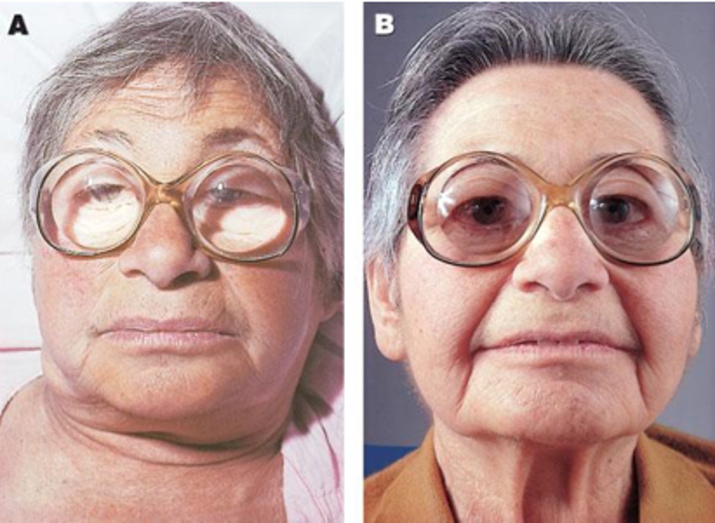 <p>organ specific: thyroid<br>- autoantibodies to thyroid tissues lead to destruction of thyroid epithelial cells<br>- t cell mediated : <br>- CD8+ cell death<br>- ADCC<br><br>symptoms:<br>- enlarged thyroid<br>- hypothyroidism<br>- usually middle-aged females<br>- may have other autoimmune diseases as well<br><br>normally in middle aged women who are predisposed to genetic conditions</p>