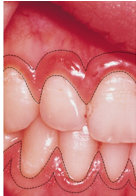 <ul><li><p>marginal and attached gingiva can become enlarged, especially the interdental papilla</p></li><li><p>results from edema occurring in lamina propria of the tissue because of inflammatory response</p></li><li><p>fluid from the lamina propria capillaries flow out to flush area of injurious agents</p></li></ul><p></p>