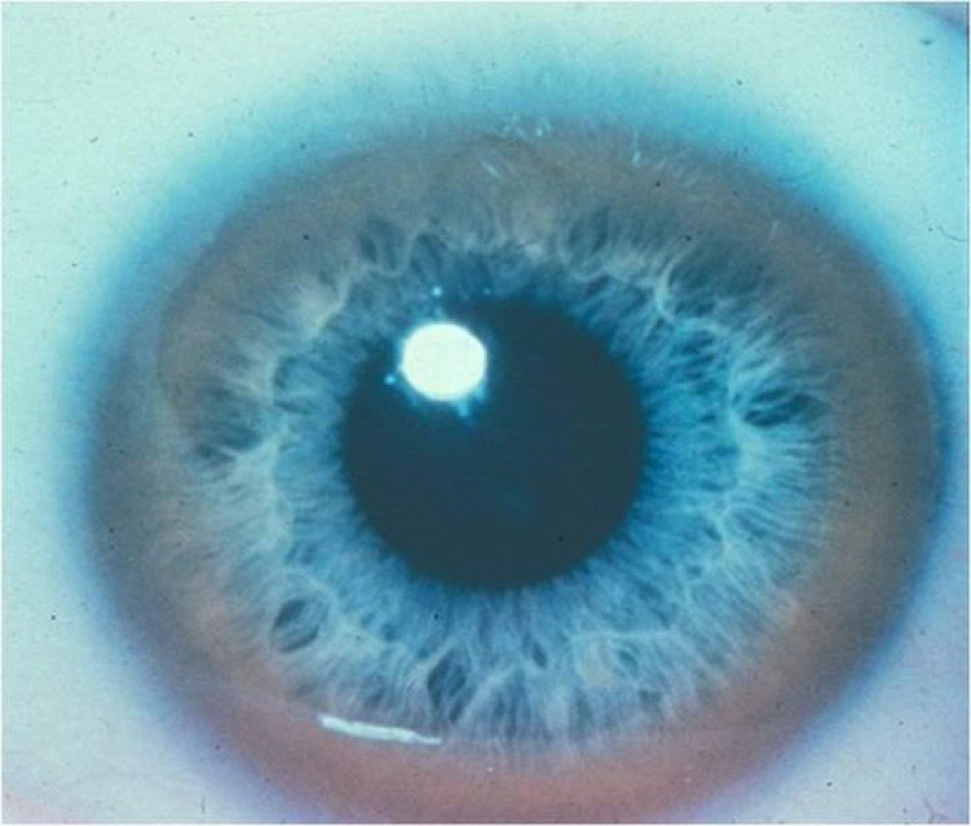 <p>Autosomal recessive movement disorder localized on chromosome 13; caused by a defect in copper metabolism</p><p>Results in lesions in the liver and lentiform nucleus (putamen)</p><p>Symptoms: psychiatric problems, personality disorders, dementia tremor, rigidity, choreiform and athetotic movements</p>