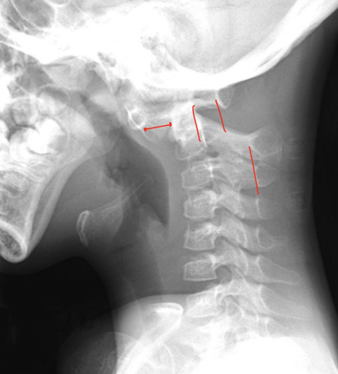 <p>What does this represent if it's a 12 year lad patient with neck pain?</p>