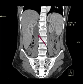 <p><span>A 49 year old male w/ PMHx of Crohn’s presents to UC w/ complaints of flank pain for the past 4 days. He was noted to have a limp when walking towards the patient room. PE was positive for pain during passive R high flexion and he prefers to sit with his knees pulled towards his chest. Abdomen was benign, no g/r/t. He was noted to have a low grade fever. Abdominal CT is as shown. Given the most probable diagnosis, which of the following is true?</span></p><ul><li><p><span>Ipsilateral flexion would relax the affected structure&nbsp;</span></p></li><li><p><span>Phrenic n. carries afferent fibers to the structure&nbsp;</span></p></li><li><p><span>L1 to L3 ventral rami are carrying pain stimulus from the affected structure&nbsp;</span></p></li><li><p><span>The affected structure is superiorly attached to rib 12&nbsp;</span></p></li><li><p><span>The affected structure is inferiorly attached to the greater trochanter</span></p></li></ul><p></p>