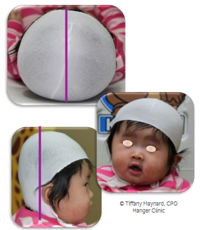 <p>Rating scale based on <strong><em>visual </em></strong>assessment criteria </p><p>Posterior only Cranial Asymmetry </p><ul><li><p>Type I - Central posterior flattening </p></li><li><p>Type II - Widening of posterior skull </p></li><li><p>Type III - Temporal bossing or posterior vertical growth </p></li></ul><p></p>