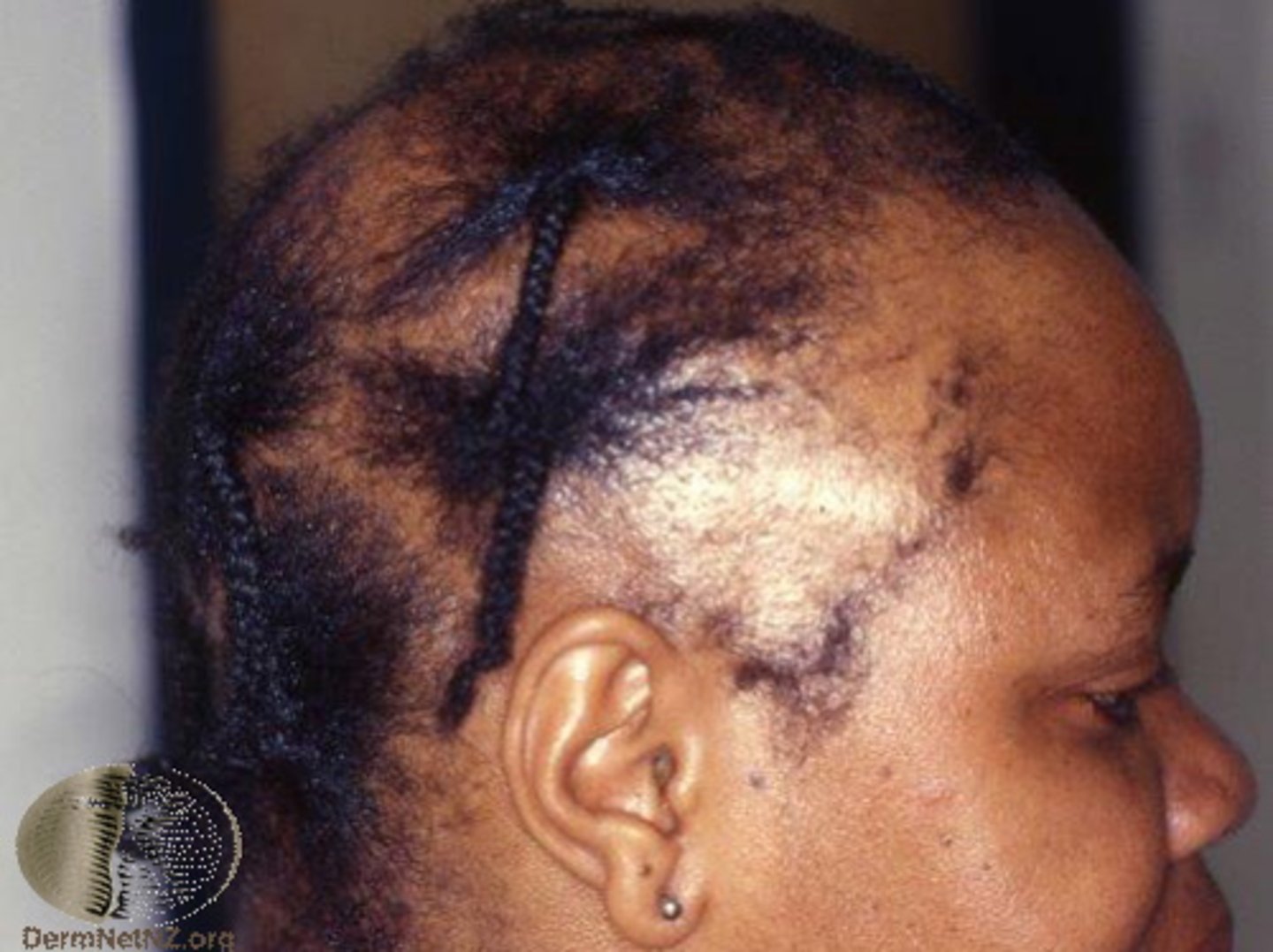 <p>Occurs as a result of pulling from hairstyles, helmets, headbands, etc</p>