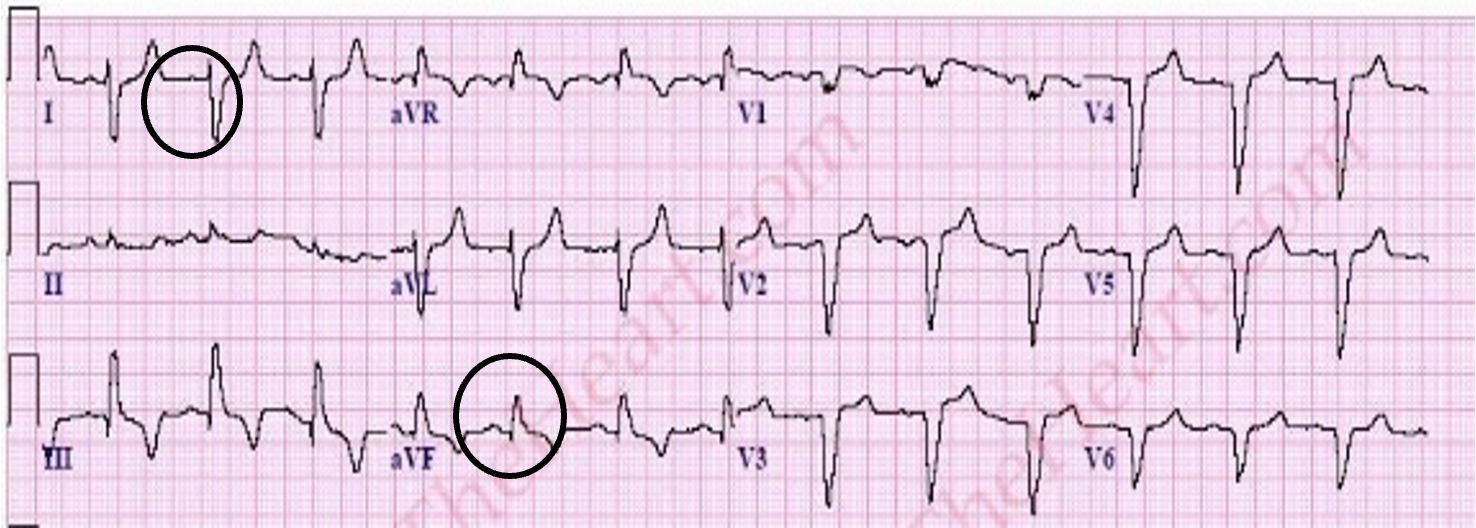 <p>I mostly neg, aVF mostly pos</p>