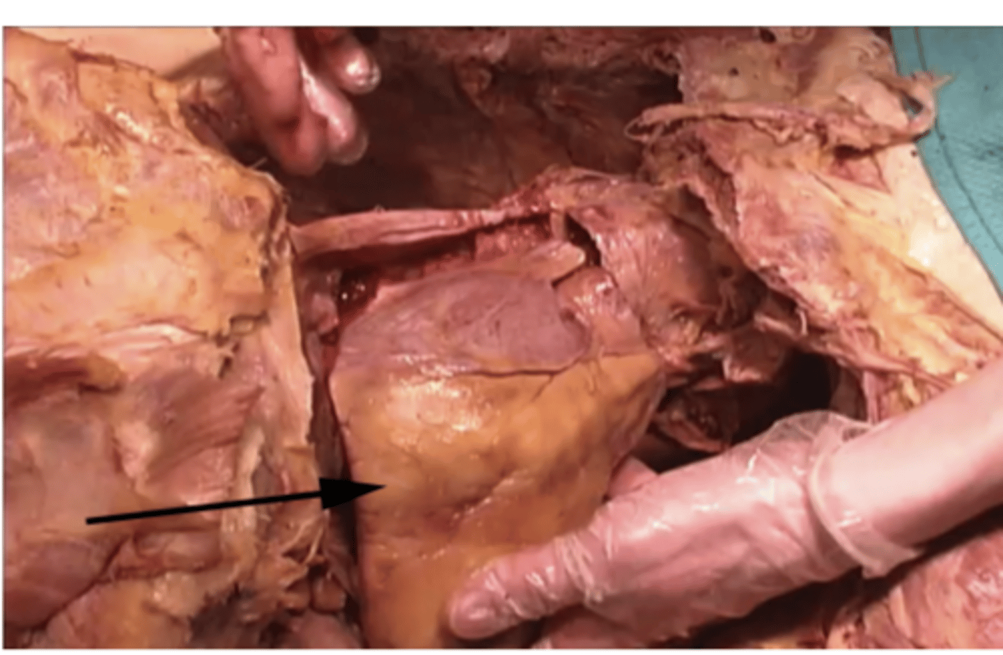 <p>To what organ is the arrow pointing?</p><p>gall bladder</p><p>liver</p><p>lung</p><p>heart</p>