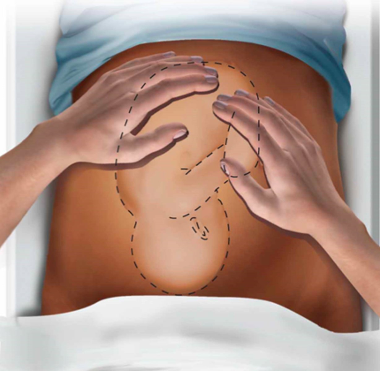 <p>Examiner places both hands on each upper quadrant of the patient's abdomen and gently palpates the fundus of the uterus with the tips of the fingers to define which fetal pole is present in the fundus</p>
