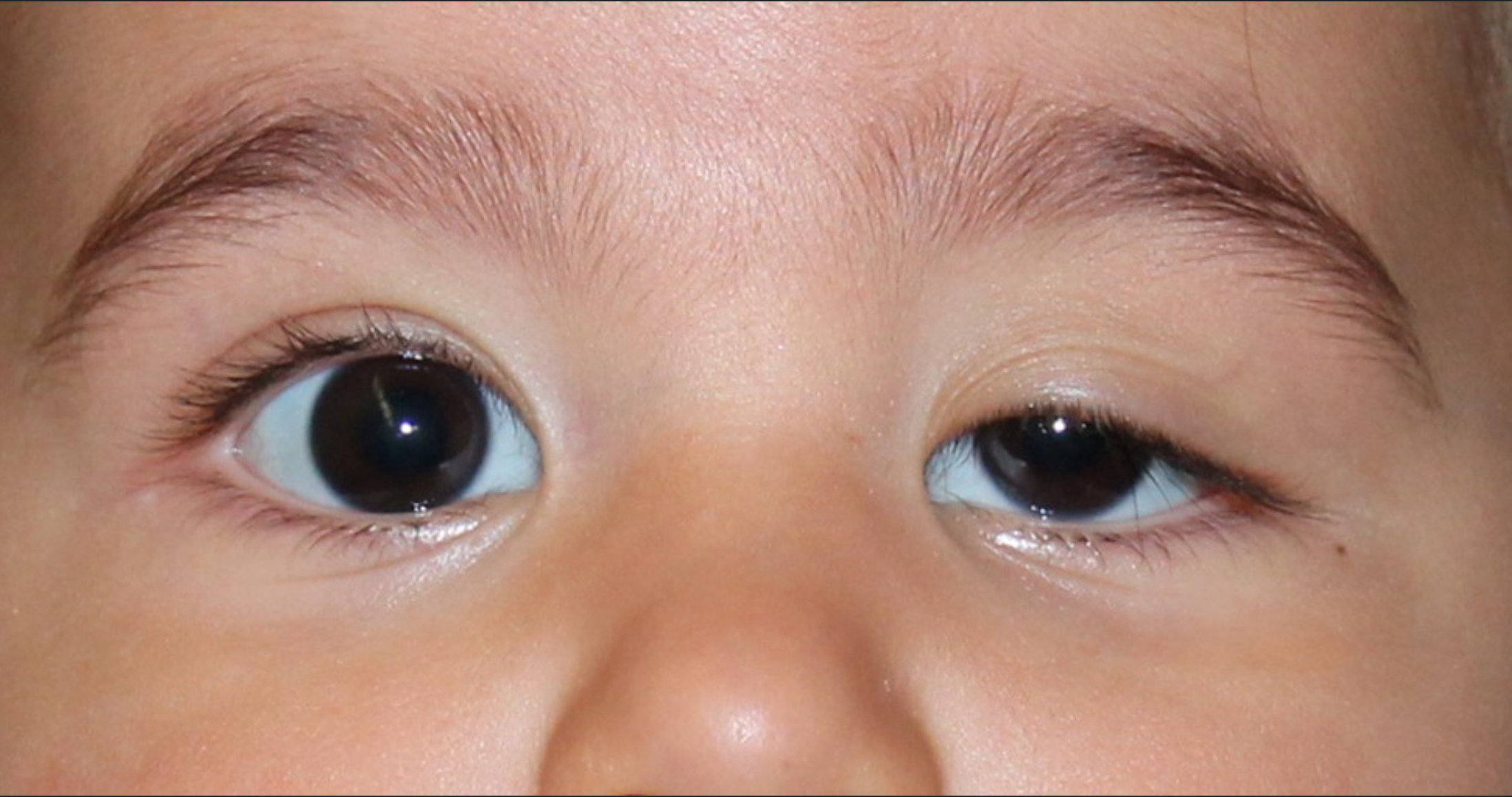 <p>Drooping of the upper eyelid, often due to CN III dysfunction. (Lazy eyelid)</p>