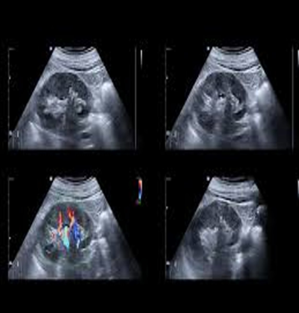 <p>Lupus nephritis appears sonographically with increased ___ and renal ___ </p>