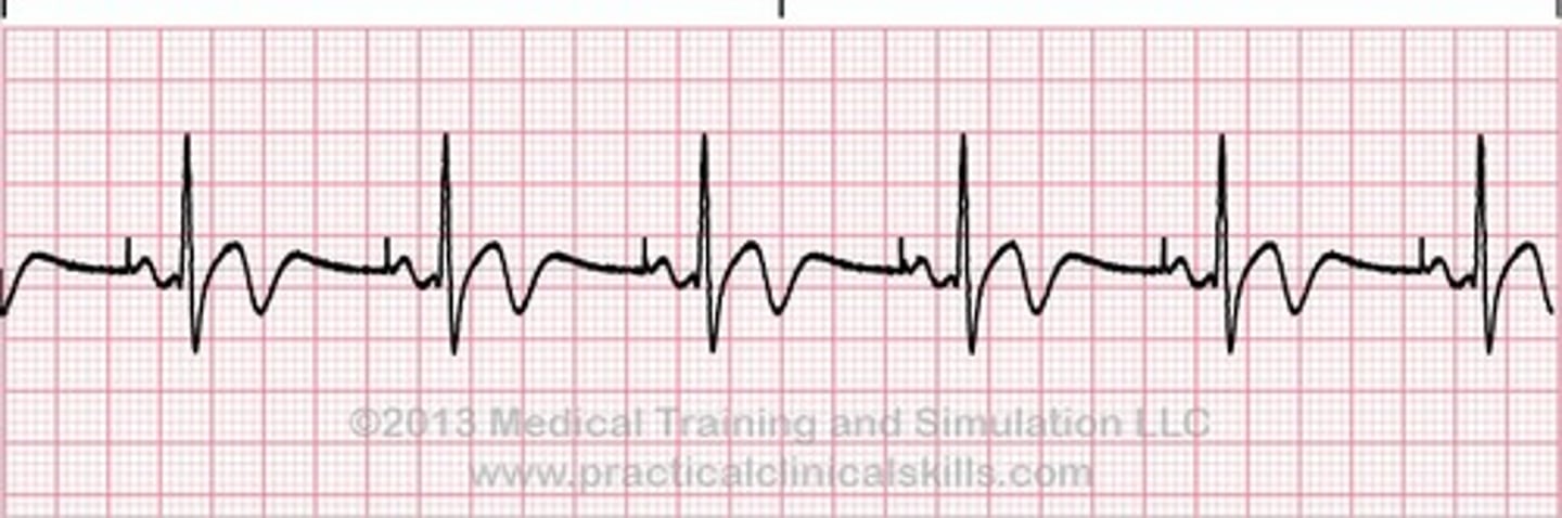 <p>The atypical vertical projections in the EKG tracing are like the result of which of the following?</p><p>A) pacemaker spikes</p><p>B) intrinsic R waves</p><p>C) intrinsic vertical anomaly</p><p>D) defibrillator spikes</p>