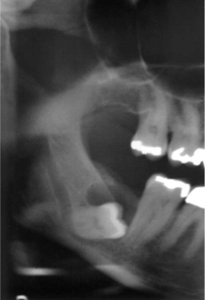 <p>This 52-year-old male was noted to have this presentation upon routine radiographic evaluation. He was asymptomatic.</p><p>What are three neoplasms that could arise in such a setting, provided</p><p>this originally was an odontogenic cyst?</p>