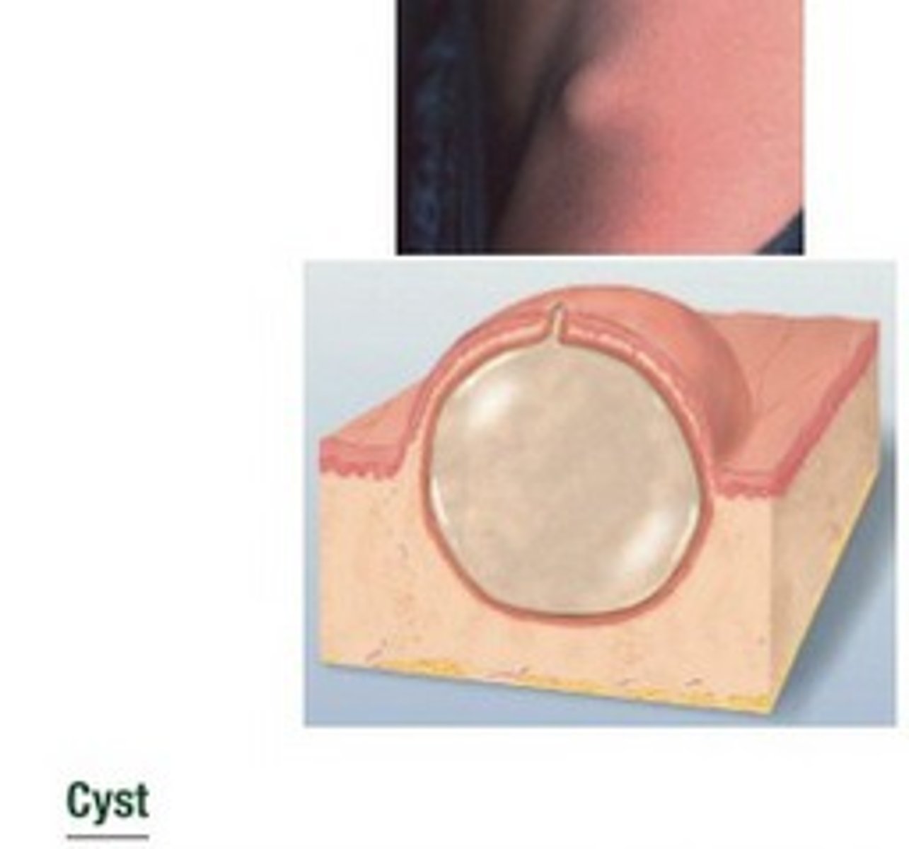 <p>encapsulated fluid-filled cavity in dermis or subcutaneous layer, tensely elevating skin</p>