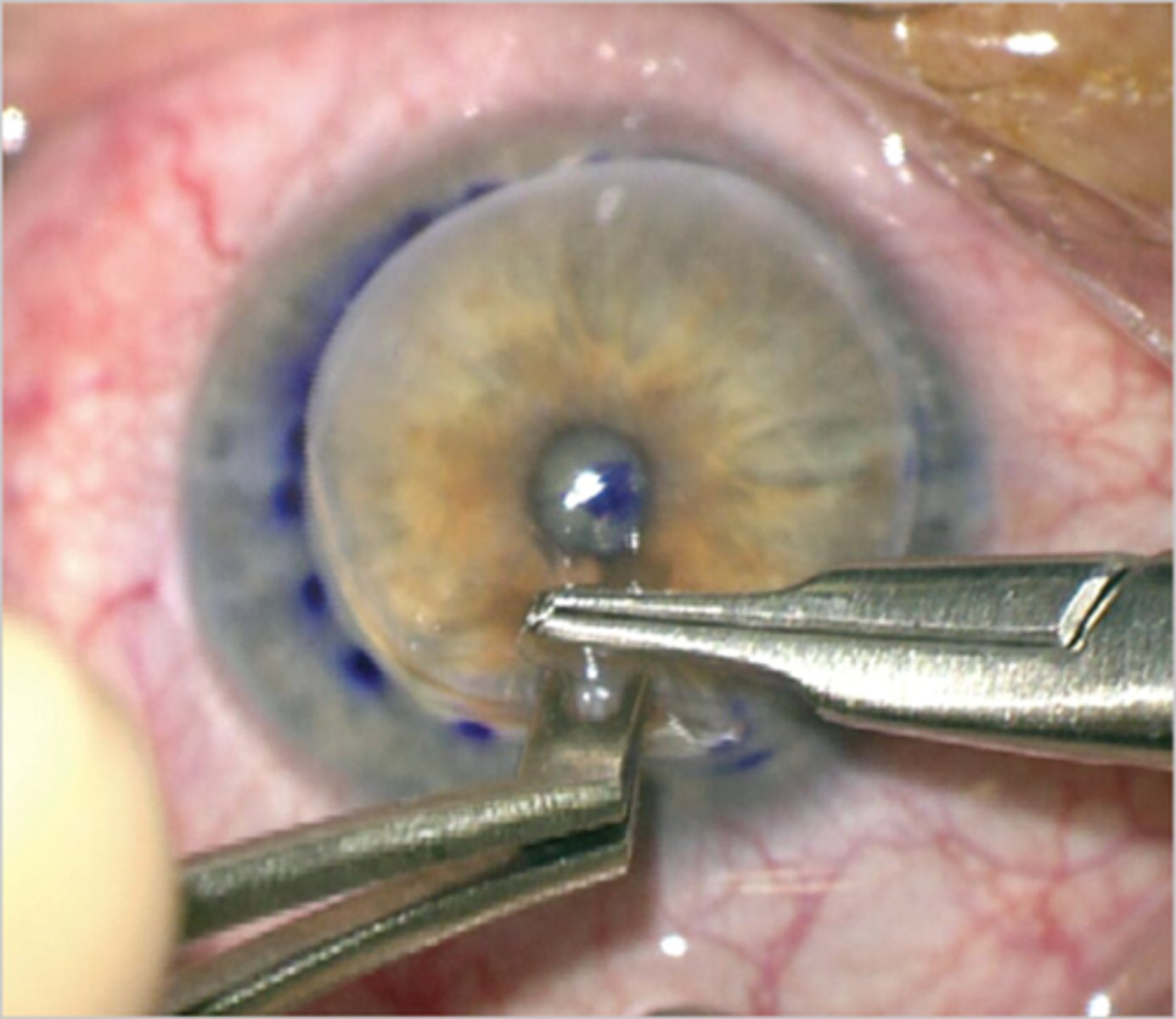 <p>What is the downside of larger grafts used in PKP?</p>