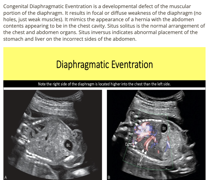 <p>d) eventration</p>