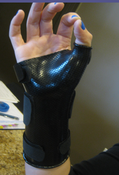 <p>Forearm Based Thumb Spica splint is used for DeQuervain’s &amp; thumb/scaphoid/trapezium/radial styloid fracture. Goals are to stabilize</p>