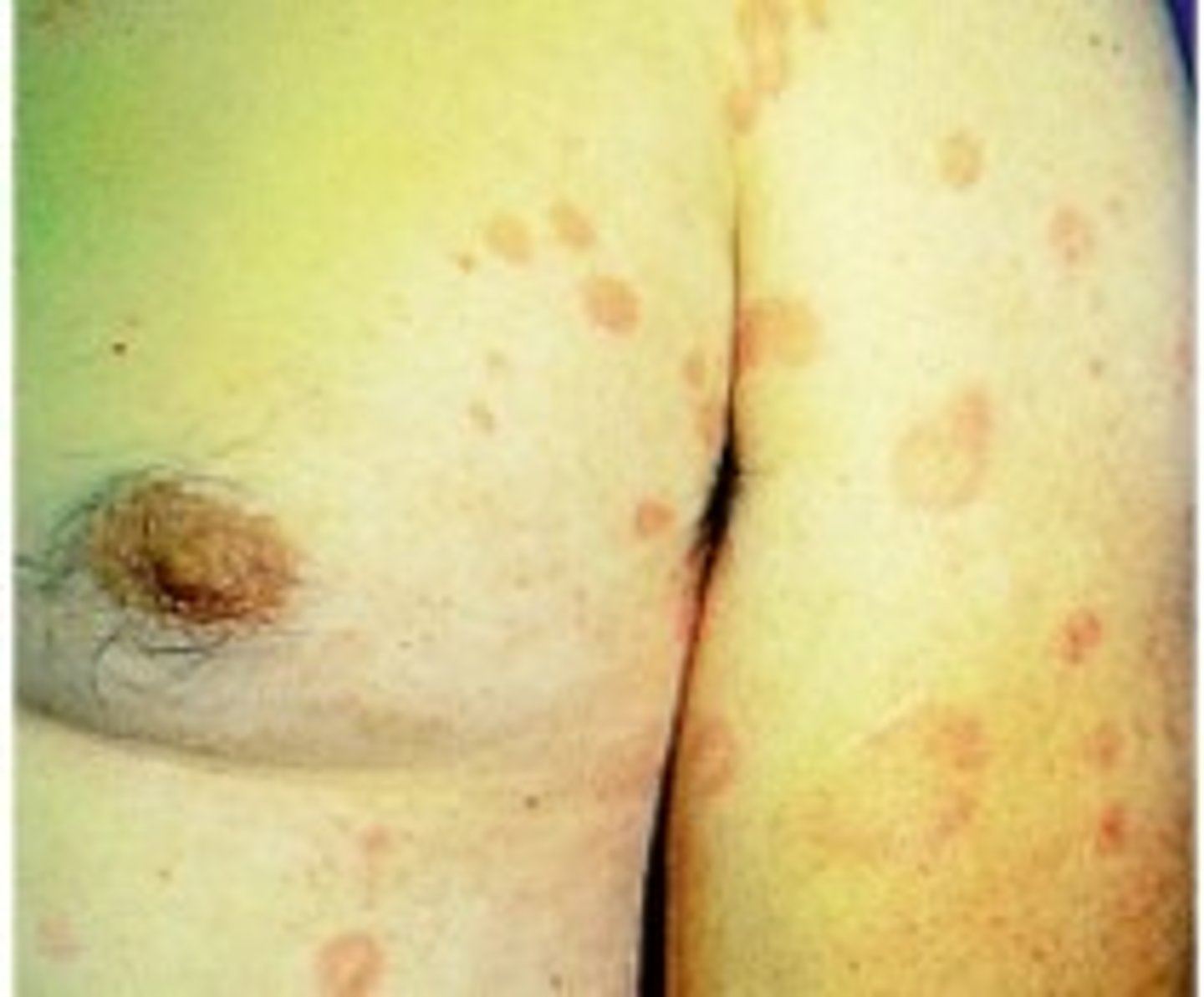 <p>-Elevated, irregular, or round, flat-topped area</p><p>-Fluid with edematous (fluid-filled) and erythematous (red)</p><p>Causes:</p><p>-Insect bites</p><p>-Allergic reactions</p><p>-Hives</p>