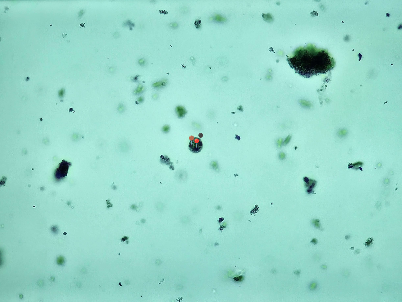 <p><strong><em>Entamoeba histolytica</em></strong></p><p>(Cysta)</p><p></p><p></p><p><strong>Organelle:</strong></p><p></p><ul><li><p><span data-name="red_circle" data-type="emoji">🔴</span><span> - ciałko chromatoidalne;</span></p></li></ul><p></p><ul><li><p><span data-name="black_circle" data-type="emoji">⚫</span><span>️</span><span data-name="brown_circle" data-type="emoji">🟤</span> - jądra komórkowe.</p></li></ul><p></p><p></p><p><strong>Parazytoza: </strong><em>Pełzakowica</em></p><p></p>