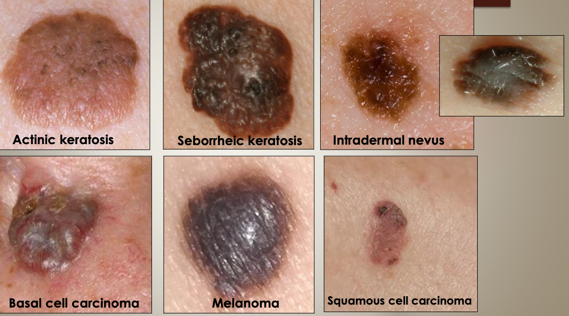 <ol><li><p>Actinic keratosis</p></li><li><p>Seborrheic keratosis</p></li><li><p>Intradermal nevus</p></li><li><p>Basal cell carcinoma</p></li><li><p>Melanoma</p></li><li><p>Squamous cell carcinoma</p></li></ol><p></p>