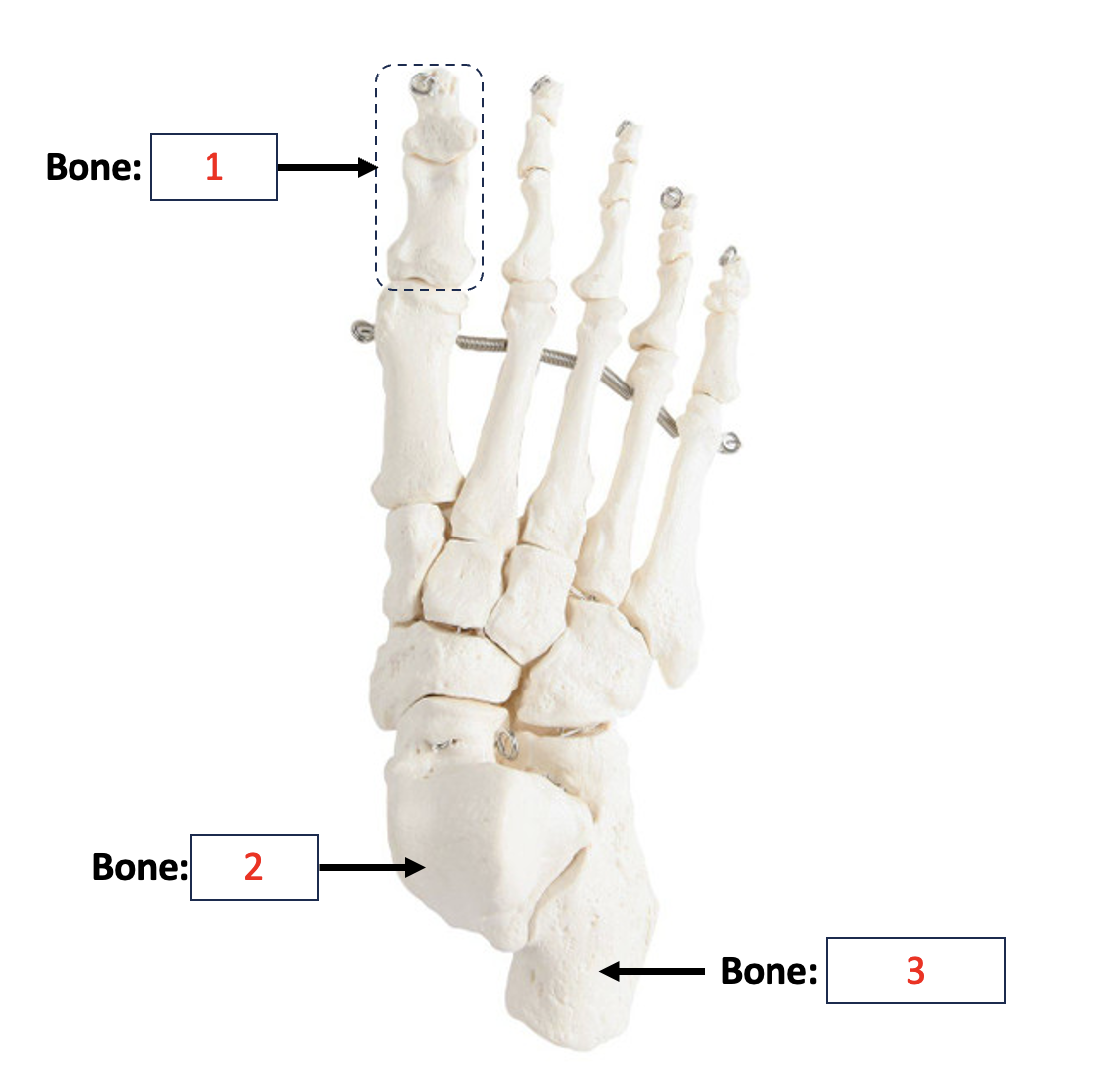 <p>Tarsals - Calcaneus&nbsp;</p>