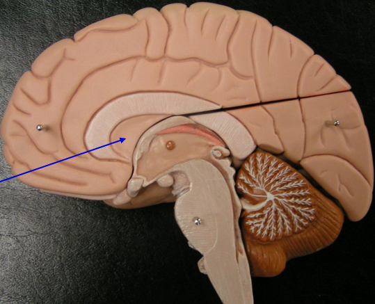 may be tagged as Lateral Ventricle