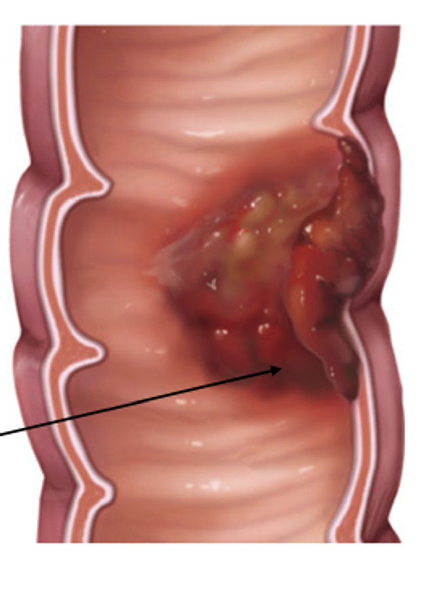 <p>aka colon, rectal, or bowel cancer</p><p>Risk Factors: lifestyle, older age, inherited genetic disorders (rare</p>