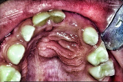<p>What is the treatment of dentigerous cyst?</p>